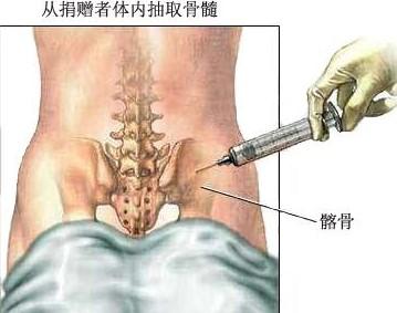 骨髓移植后需要注意什么？