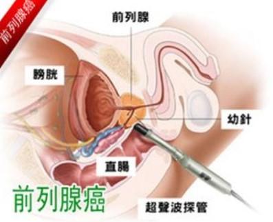 前列腺癌的早期癥狀是什么？