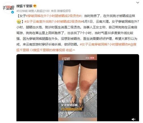 云南女子穿破洞褲7小時(shí)腿被曬傷，溫度30多度紫外線強(qiáng)烈